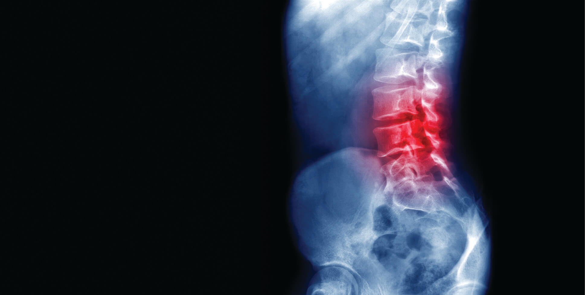 Physiotherapy management of sciatica