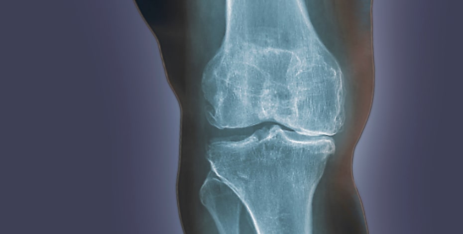 Five facts about … osteoarthritis
