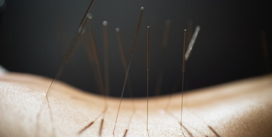 Acupuncture and dry needling for musculoskeletal pain