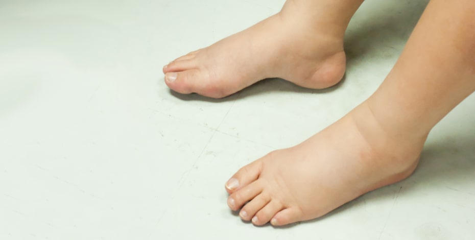 Five facts about lymphoedema