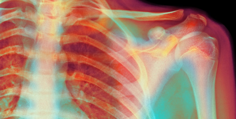 Subacromial impingement: is it time we finally abandoned the term?