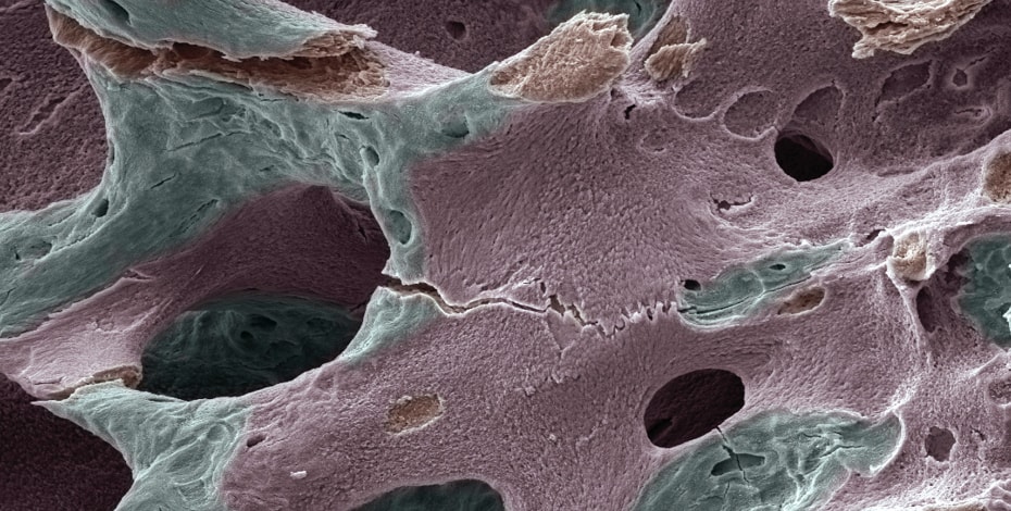 Breaking the cycle of repeat fractures