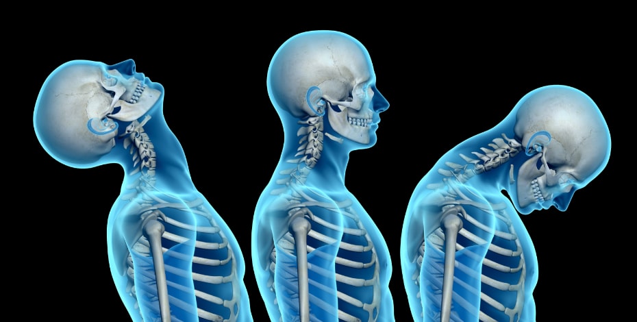 Exploring ways forward with whiplash